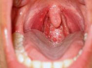Cổ họng nổi mụn thịt có triệu chứng và điều trị thế nào?