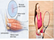 Hội chứng Tennis Elbow là gì? Nguyên nhân, triệu chứng và cách điều trị 