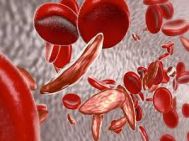 Bệnh Tan Máu Bẩm Sinh - Thalassemia