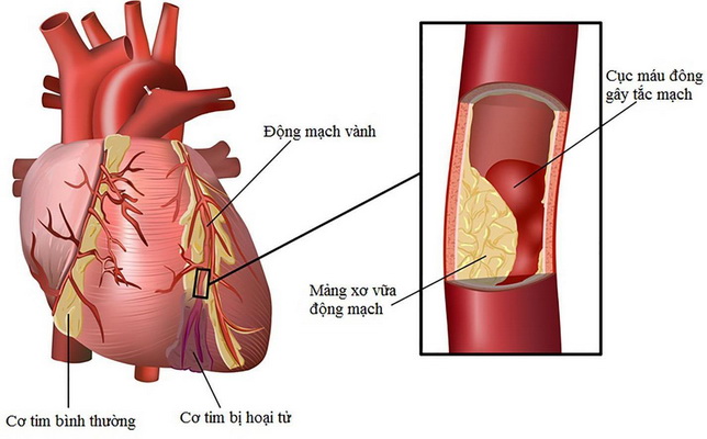 Cách nhận biết bệnh tim cơ bản